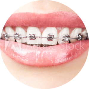 Braces