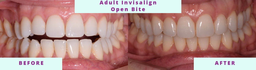 Adult Invisalign Before and After
