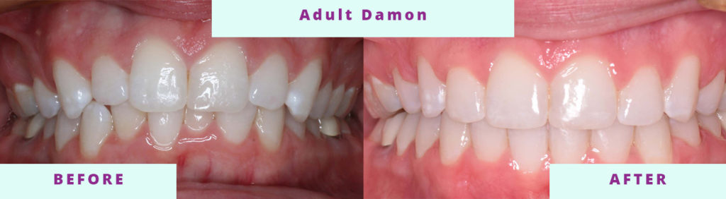 Adult Damon Before and After