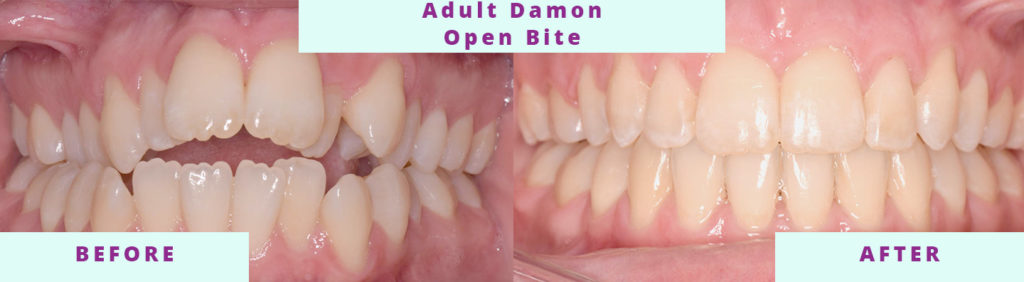 Adult Damon Open Bite Before and After