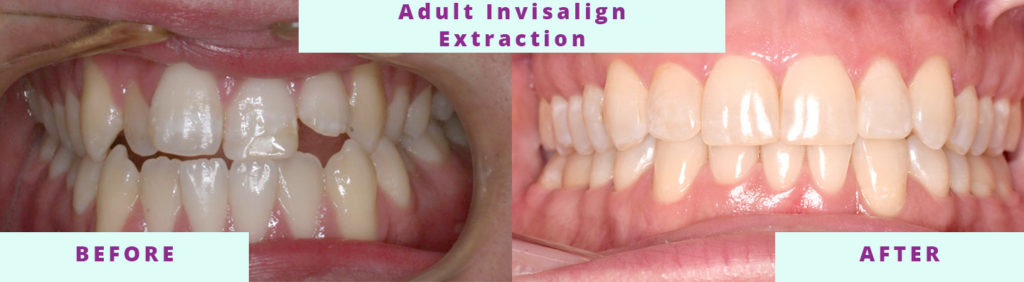 Adult Extraction Before and After