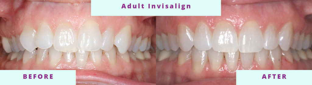 Adult Invisalign Before and After