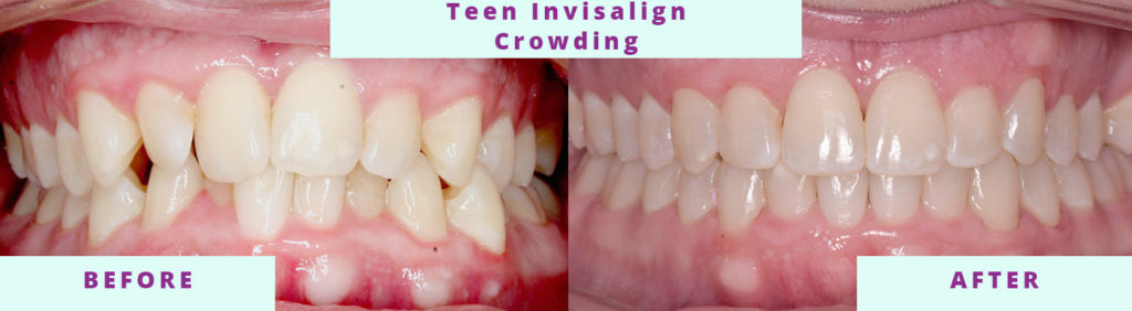 Crowding Before and After