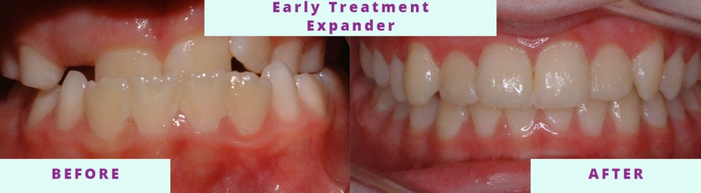 Early Treatment Expander Before and After