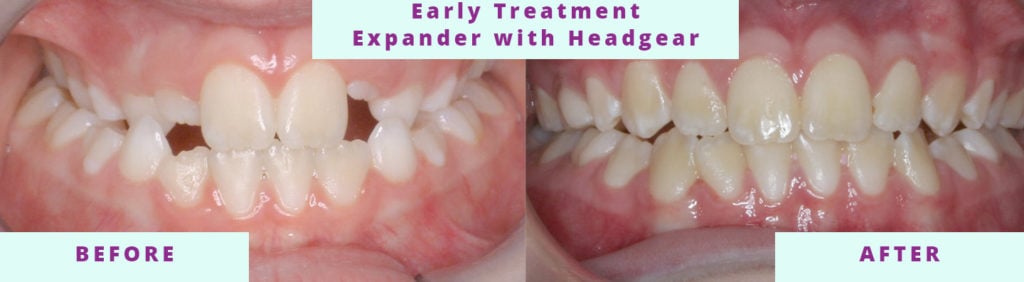 Early Treatment with Headgear Before and After