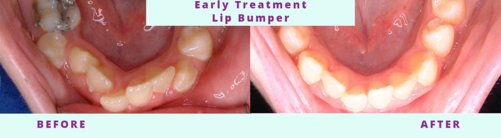 Lip Bumper Before and After