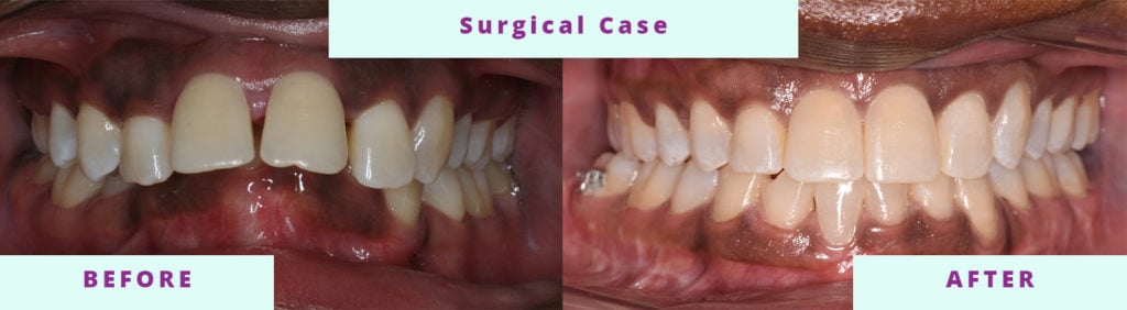 Surgical Before and After