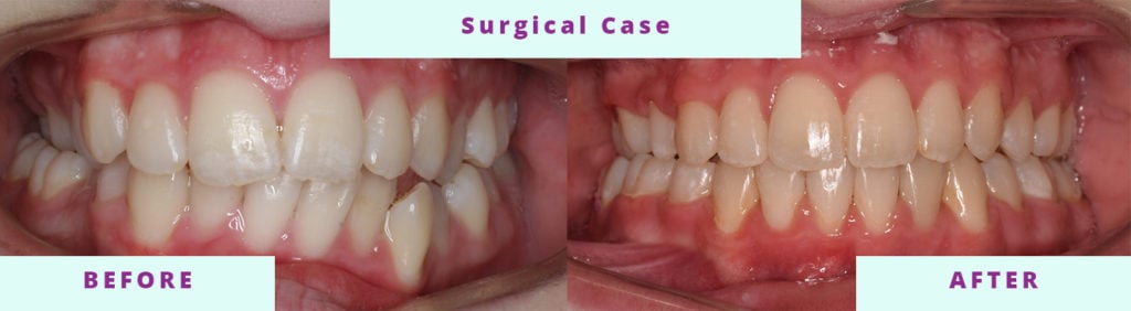Surgical Before and After