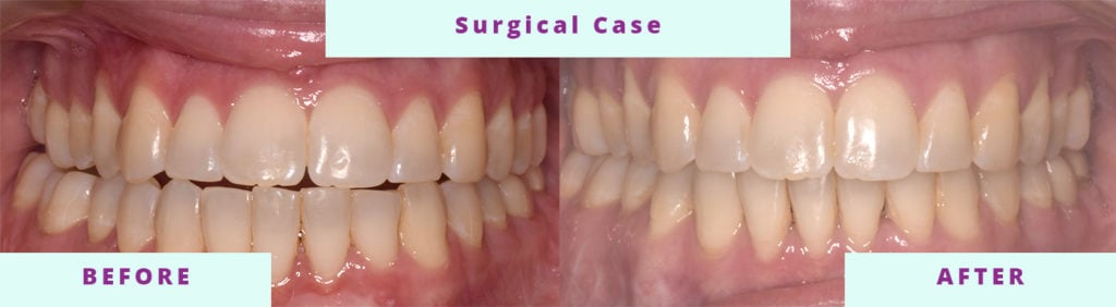 Surgical Before and After