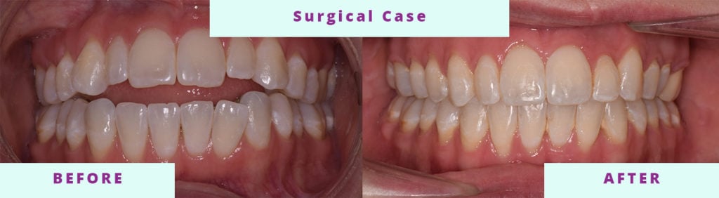 Surgical Before and After