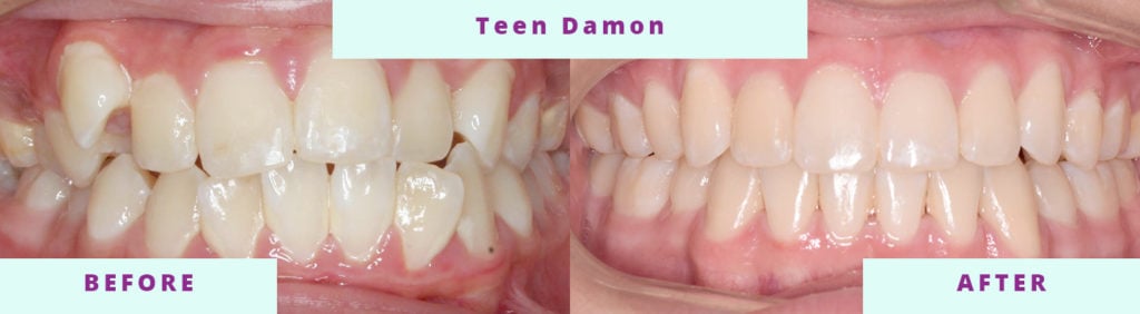 Teen Damon Braces Before and After