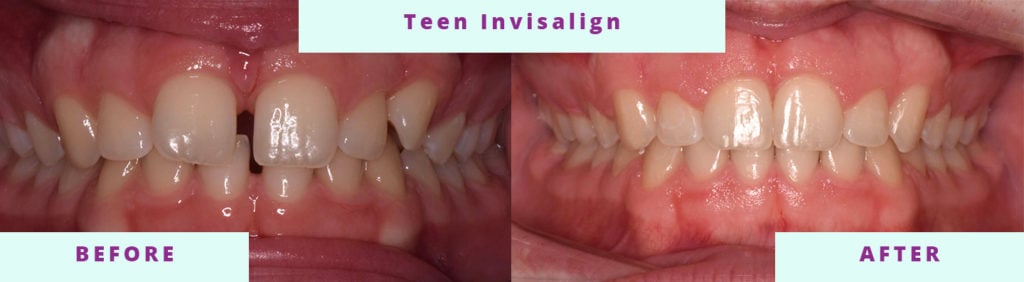 Teen Before and After