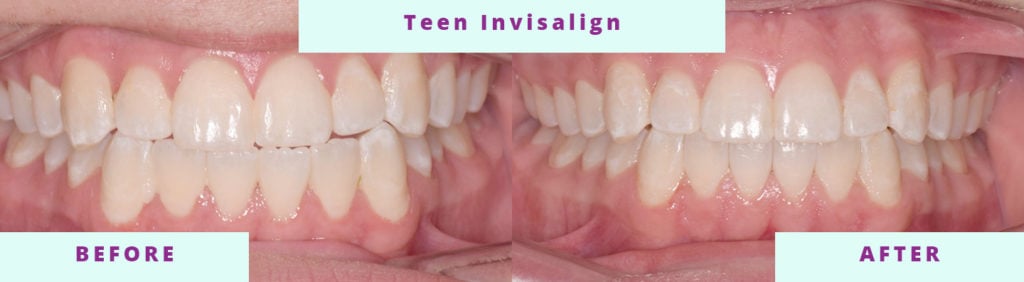 Teen Before and After